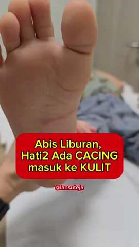 Habis main pantai, hati2 ada cacing masuk ke kulit kaki anak! Ini uda kasus ketiga saya minggu ini karena banyak yang habis liburan di pantai. Kalau dibiarkan, salah2 cacingnya masuk ke darah dan bisa ke paru2, menyebabkan batuk kronis pada anak lho. Segera bawa ke dokter ya untuk berobat. Kalau spray2 yang sering muncul di medsos itu tidak disarankan lho yaaa⚠️⚠️