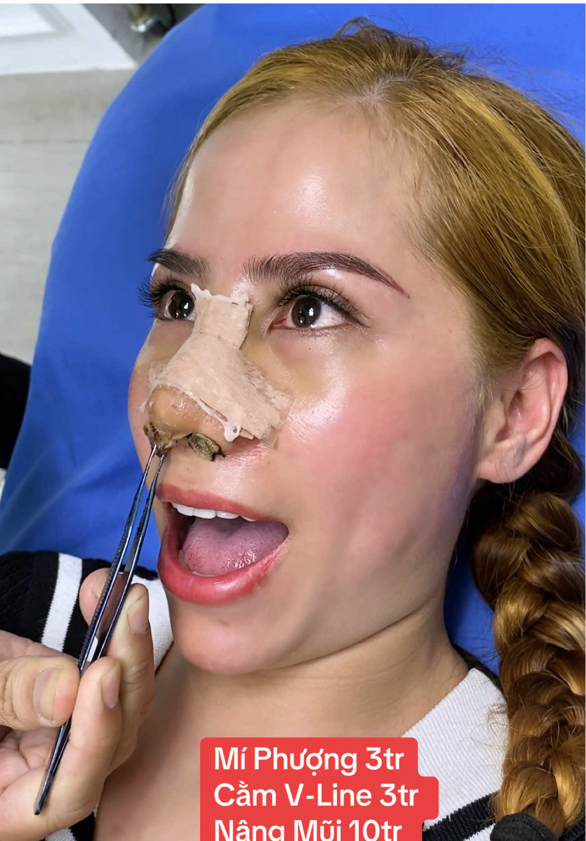 Có ai thích cảm giác Rút Bông Mũi này bên Dr-Sơn không nhỉ? #drson #nangmui #nangmuicautruc #nangmuidep #operasihidung #nose #Indonesia #Thailand #malaysia #angkathidung #rhinoplasty #cosmeticsurgery #Eyelidsurgery #Facelift #kualalumpur 
