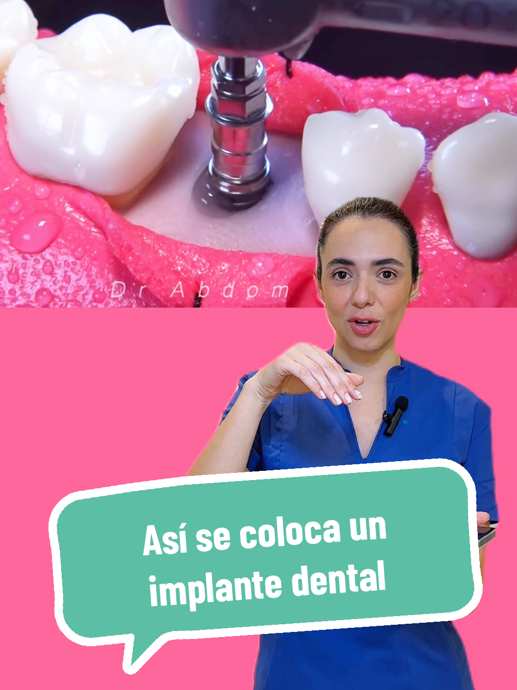 Así se coloca un implante dental. Lo primero es extraer el diente que está afectado. En la misma cirugía se puede colocar el implante. O en otros casos se puede esperar a que se forme hueso y ponerlo en una cirugía posterior. Una vez colocado el implante, se espera la osificación, es decir que el implante se adhiera al hueso. Este proceso lleva 4 a 5 meses. Posteriormente se coloca la corona del implante #implantesdentarios #cirugiadental #dentistas #odontologia #