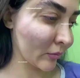 للبنات احظري حقن الفيلم لكي لا يحدث معكي هكذا 👇 فتاة توثق تشوّه وجهها بعد حقنها للفيلر! 🤯💔 #TikTokLIVE 