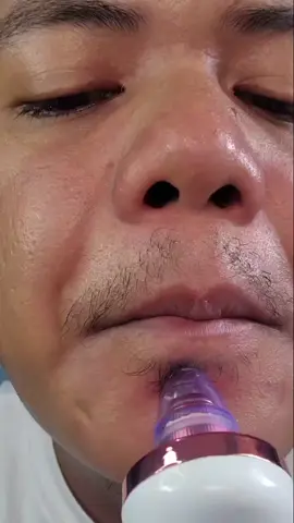 Pang Unli Harvest ng Whiteheads. Check out na #whiteheads #whiteheadsremoval #vacuumwhiteheadremover #whiteheadsremoval #whiteheadsblackheadsremoval