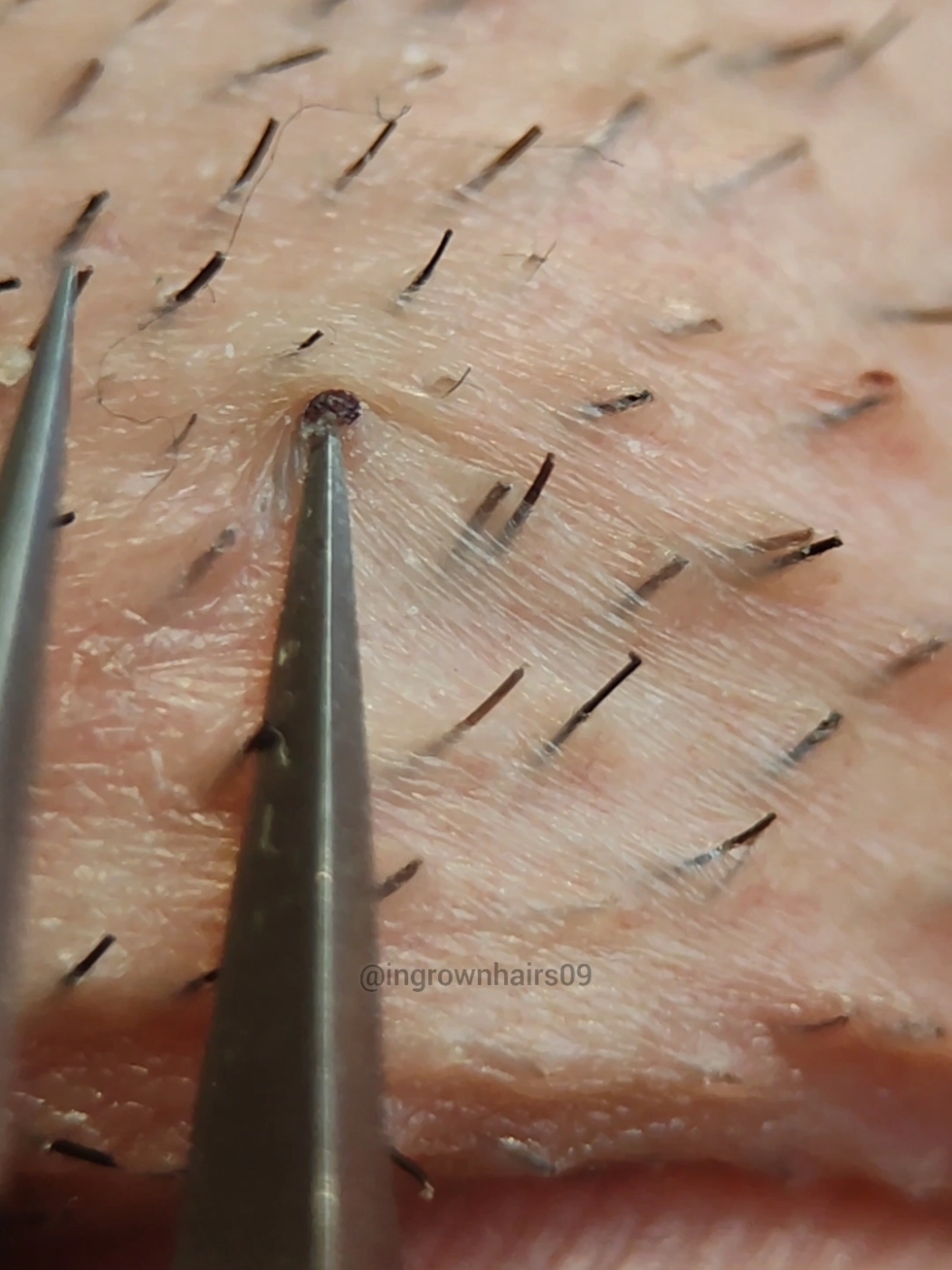 satisfying ingrown hair extractions! #relax #asmr #ingrownhairremoval #satisfyingvideo #ingrownhair #extractions #tweezers #hairpulling 
