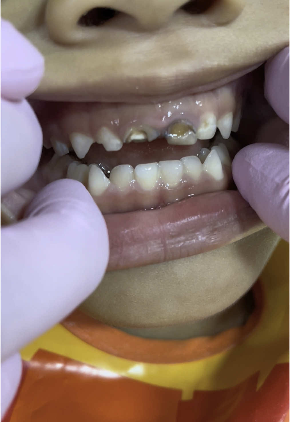 Cuando los papás dicen: “Son solo dientes de leche.” Y así los dejan…😹#P#perdonarte #emilia #C#CariesInfantilparat #foryoupage❤️❤️ #caries 