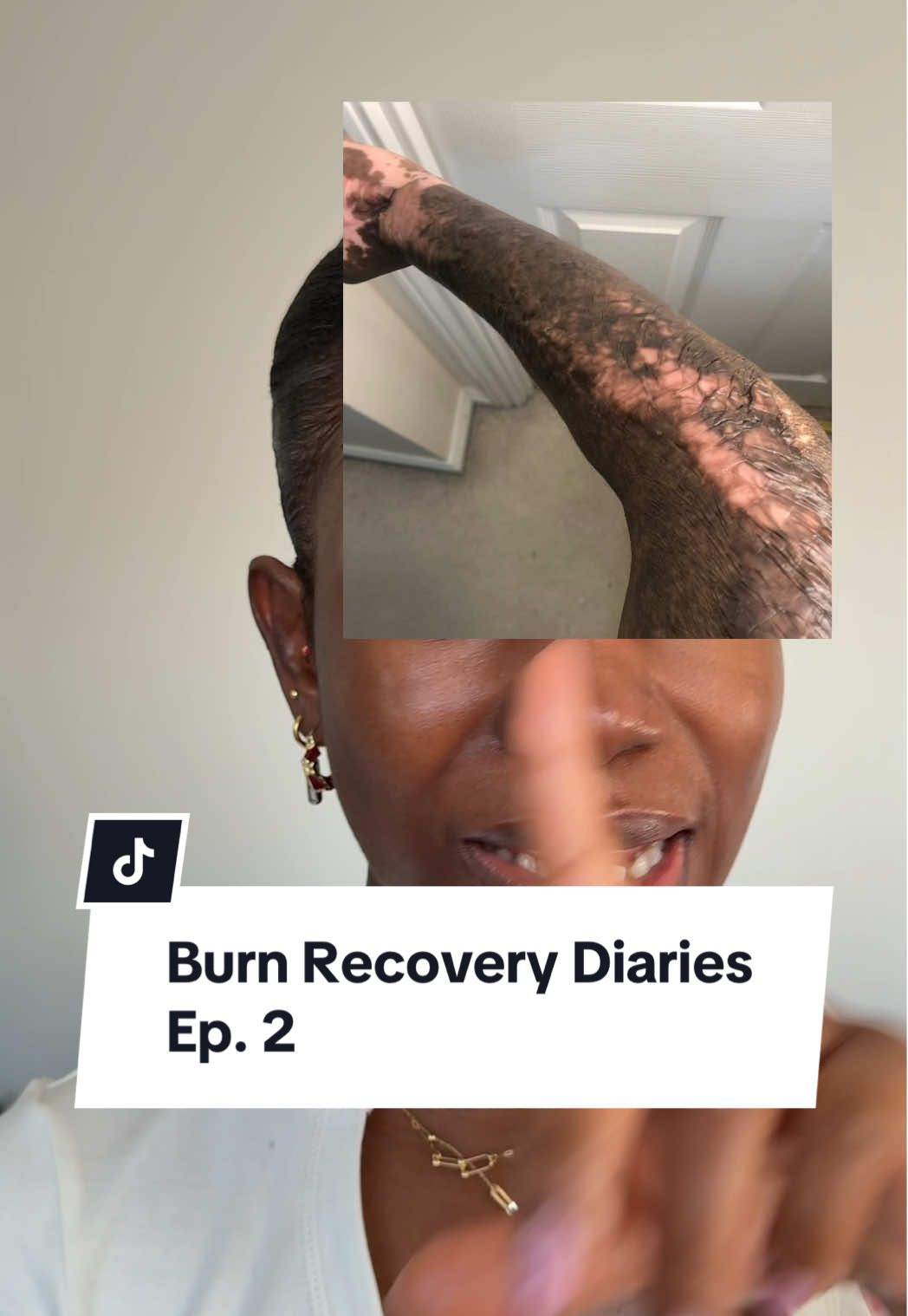 Replying to @Joy Ujoh  Fractional laser was a major step in my healing journey—it helped with texture, pigmentation, and tightness. In this series, I’m sharing my burn recovery journey and everything that’s worked for me: laser treatments, skincare, chemical peels. #burnscars #burnscar #burnscarhealing #fractionallaser #fractionalco2laser #laserforscars #skinhealing #hyperpigmentationtreatment #scartreatment #skincareforscars #skinhealingjourney #co2laser 