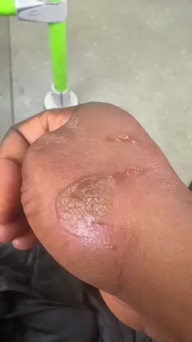 heal your burn marks and skin pigmentation with yoxier scar cream #creatorsearchinsights  #fyp #foru 
