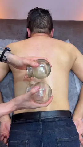 Don’t Forget to Like! 😍💙 #Cupping #massage 