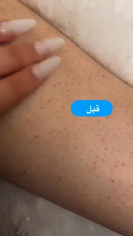 لعلاج جلد الوزه وتفتيح القدم الحل عنا 🥰