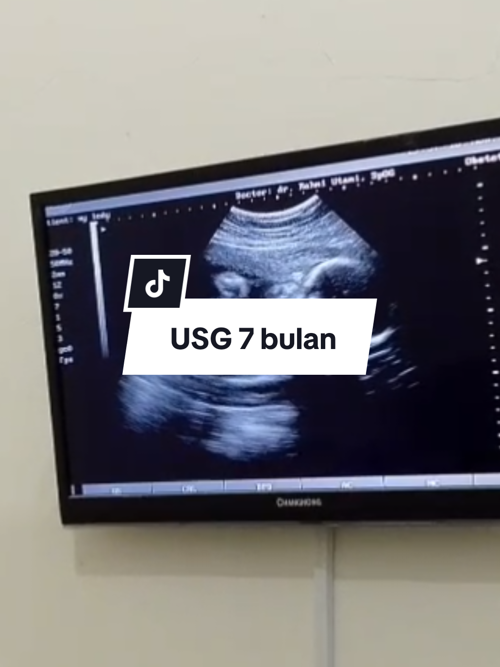 USG 7 bulan sudah kelihatan jelas Jenis kelaminnya berubah jadi cowok Hehehe Alhamdulillah bahagia sekali abymu mwndengarnya 