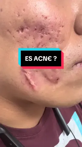 El ACN€ puede dejarnos varios tipos de cicatric€s como atroficas, hipertroficas o queloides… y un mismo paciente puede presentar varios tipos a la vez… por eso es que combinamos tratamientos para obtener los mejores resultados 🤩 Dra. Jackelyn Montero Médico Dermatologa  Lima - Perú 🇵🇪  Wsp : +51989093766 #fyp #acne #acnetreatment #acneskin #acnefithger #dermatologia #dermatologo #acnescars #secuelasdeacne #cicatrices 