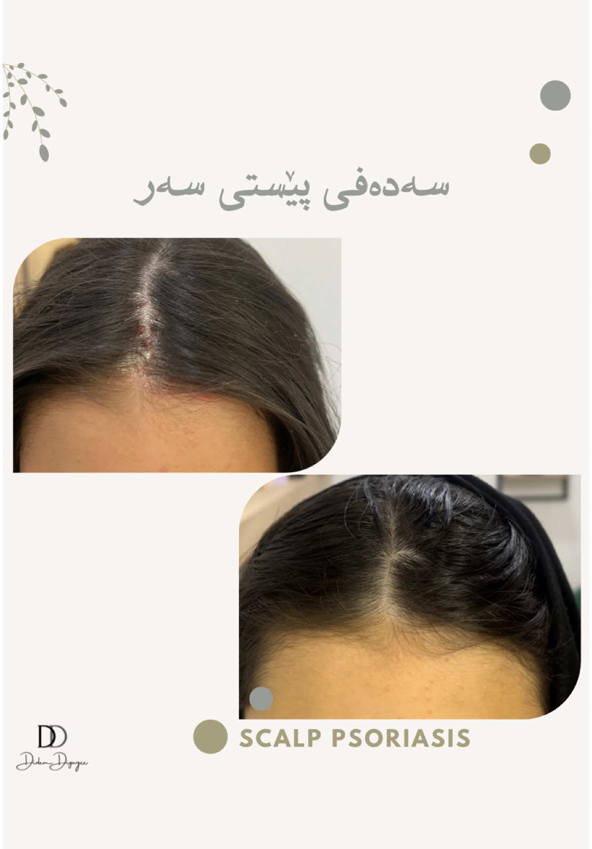 Skin Healing 💫 Scalp psoriasis.. Before & After 📍 Naz Naz Boulevard Street  📲 0750 208 00 18   #skincare #skintreatment #acnetreatment #pigmentation #aging #skintherapist #skinhealth #skingoals #skinroutine #glowingskin #erbil #kurdistan #slemani #duhok #karkuk #healthy #healthylifestyle #healthyskin #clearskin #skincareroutine #skincareproducts 
