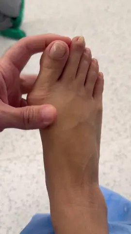 #joanete #joanetesemdor #bunion #halluxvalgus 