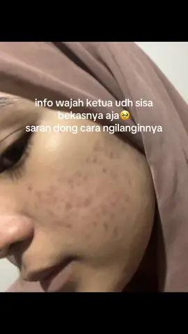 saran dong🤏#bekasjerawat #acnescars #bopeng #pih #pie #acne #fyp #fypage 