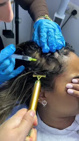 Hair mesotherapy is a treatment method performed by injecting vitamins, minerals, amino acids and growth factors that nourish hair follicles into the scalp. It reduces hair loss, supports new hair growth and strengthens the hair ✨💉 #tbilisi🇬🇪 #georgia🇬🇪 #mesotherapy 