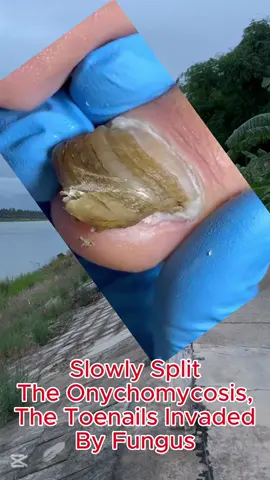 #ingrowntoenail #toenails #onychomycosis #toenailremoval #pedicure #cleaning #satisfyingvideo #asmr #usa🇺🇸 