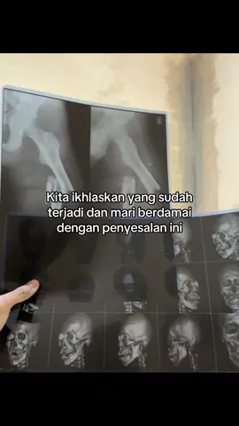 sabar terus kapan marine🤷‍♂️#patahtulang #frakturfemur #frakturmanibula #fyp 