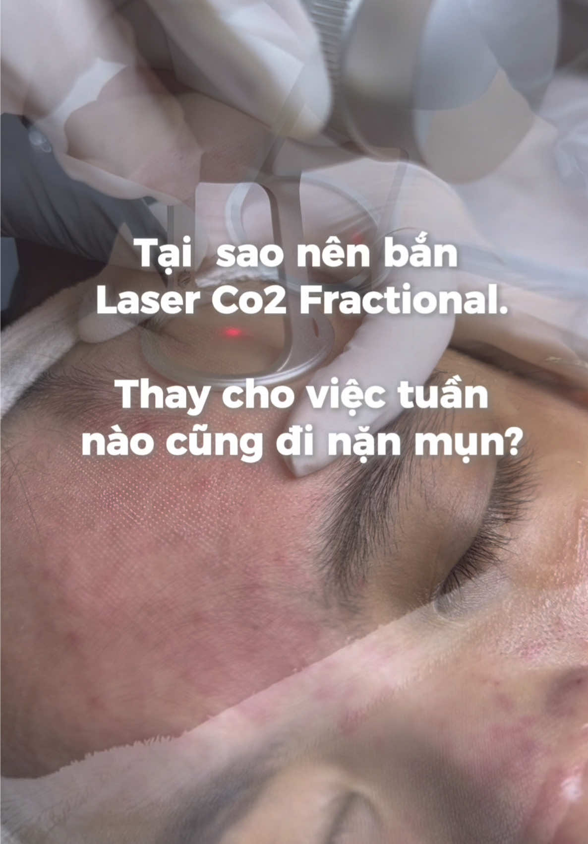 Laser CO2 Fractional có khả năng ti.êu diệt vi khuẩn gây mụn và giúp giảm nguy cơ tái phát mụn Giảm viêm và sưng tấy và giúp giảm viêm +  sưng tấy của da do mụn gây ra.#43danang #trimundanang #spadanang #nam #chamsocdamat #nanmunchuanykhoa #laserco2 #laserco2franctional 