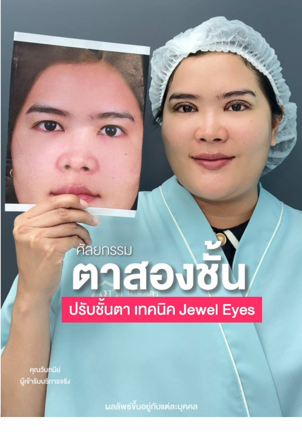 ปรับชั้นตาให้แลดูสดใส เป็นธรรมชาติยังคงความเป็นตัวเอง 👀✨   #TheArtClinic #ดิอาทคลินิก #ศัลยกรรมตา2ชั้น #ศัลยกรรมตา #ศัลยกรรมตาสองชั้นดิอาทคลินิก #รีวิวตาสองชั้น #กล้ามเนื้ออ่อนแรง #เปิดหัวตา 