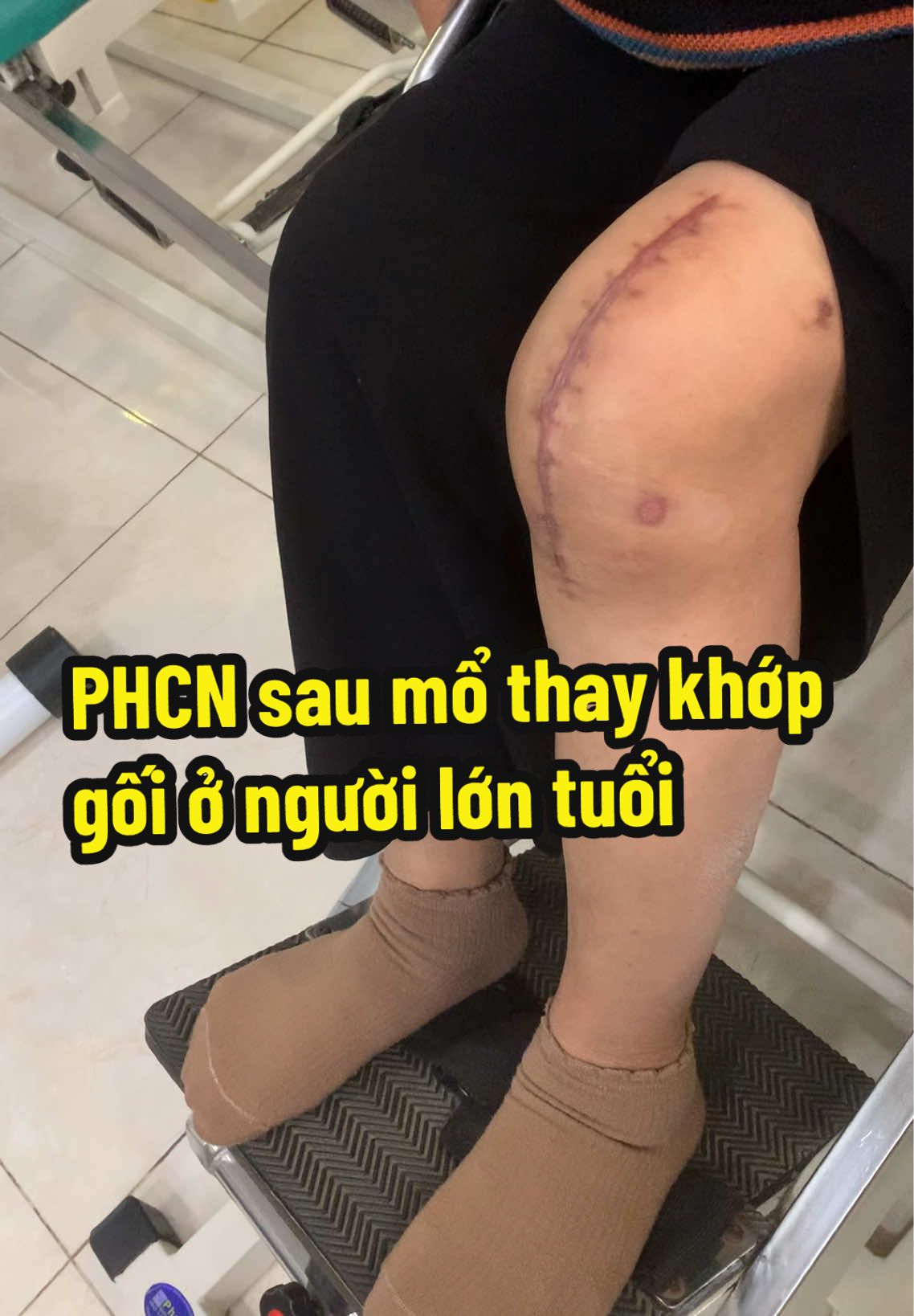 Phcn sau thay khớp gối nhân tạo ở người lớn tuổi, không phải thay xong là xong đâu mọi người nhé, thay xong mà không tập phục hồi sớm chân vẫn cứng như thường và khi cứng thì tập luyện sẽ rất khó khăn! #thaykhopgoi #bacsiquynhphcn #xuhuongtiktok #cungkhop 