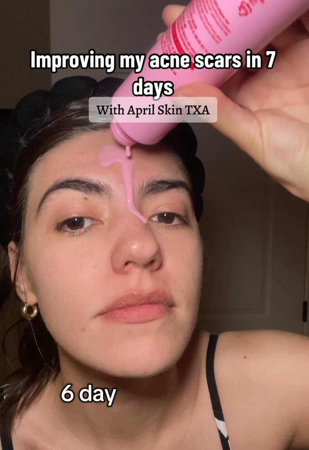 Improving my acne scars with @APRILSKIN USA TXA line. For 7 days I tried these 2 products after cleansing. First the toner following with the TXA serum.  Love how brighter my skin is and it definitely helps to decrease the hyperpigmentation and the acne scars.  #aprilskin #aprilskindarkspotspiculeserum #acnescars #hyperpigmentation #skintok #tiktokshopnewarrivals 