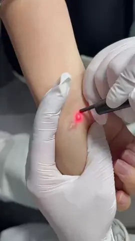 Xử lý sẹ.o lồi bằng máy laser CO2 fractional chính hãng. Liên hệ mu.a máy #truongtienmed #co2fractional_laser #co2laser #sẹorỗ #sẹo #sẹo_lồi #điều_trị_sẹo_rỗ_lâu_năm 