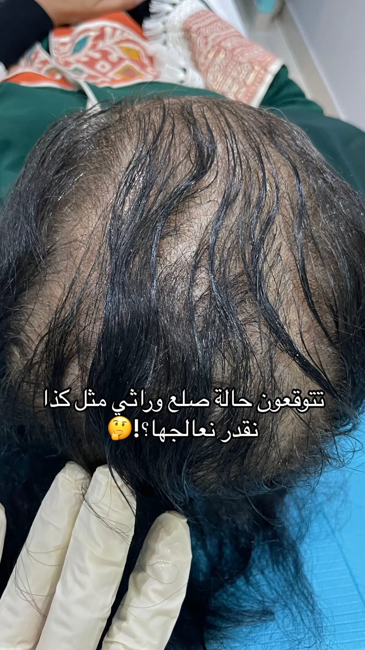 خلي ثقتك في الله كبيرة وابدئي علاج الحين  مع خطة مدروسة وكورسات كل شهر نضمن لك كثافة شعر من جديد 😍🔥 . @dr.Lobna Ahmed  . . #صلع_وراثي #شعر #كثافة_الشعر #اكسبلور #الرياض #اكسبلورexplore #عيادات_تجميل #fypシ゚ #foryoupage 