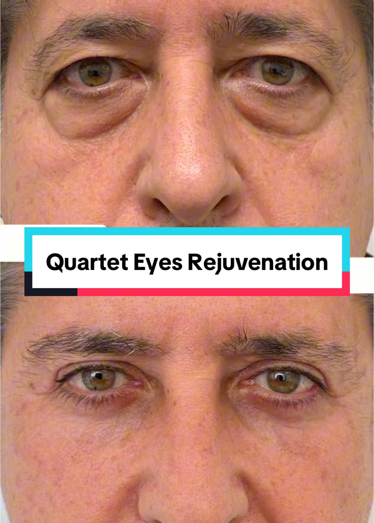 The answer is absolutely! This handsome patient is now feeling and looking great after  the power of The 𝐐𝐮𝐚𝐫𝐭𝐞𝐭: a combination of 4 procedures Brow lift + Upper Lid Blepharoplasty + Lower lid Blepharoplasty + Fat Transfer. When done together the results are synergistic in creating a youthful appearance to the eyes and face. The results speak for themselves. Mission accomplished 👌 For more info or to book a consultation:  🌎 www.torontoeyelidsurgery.com ☎️416-962-5005 📬info@torontoeyelidsurgery.com #plasticsurgeonsoftiktok #blepharoplsty #beforeandafter #toronto #eyebags #tiredeyes 