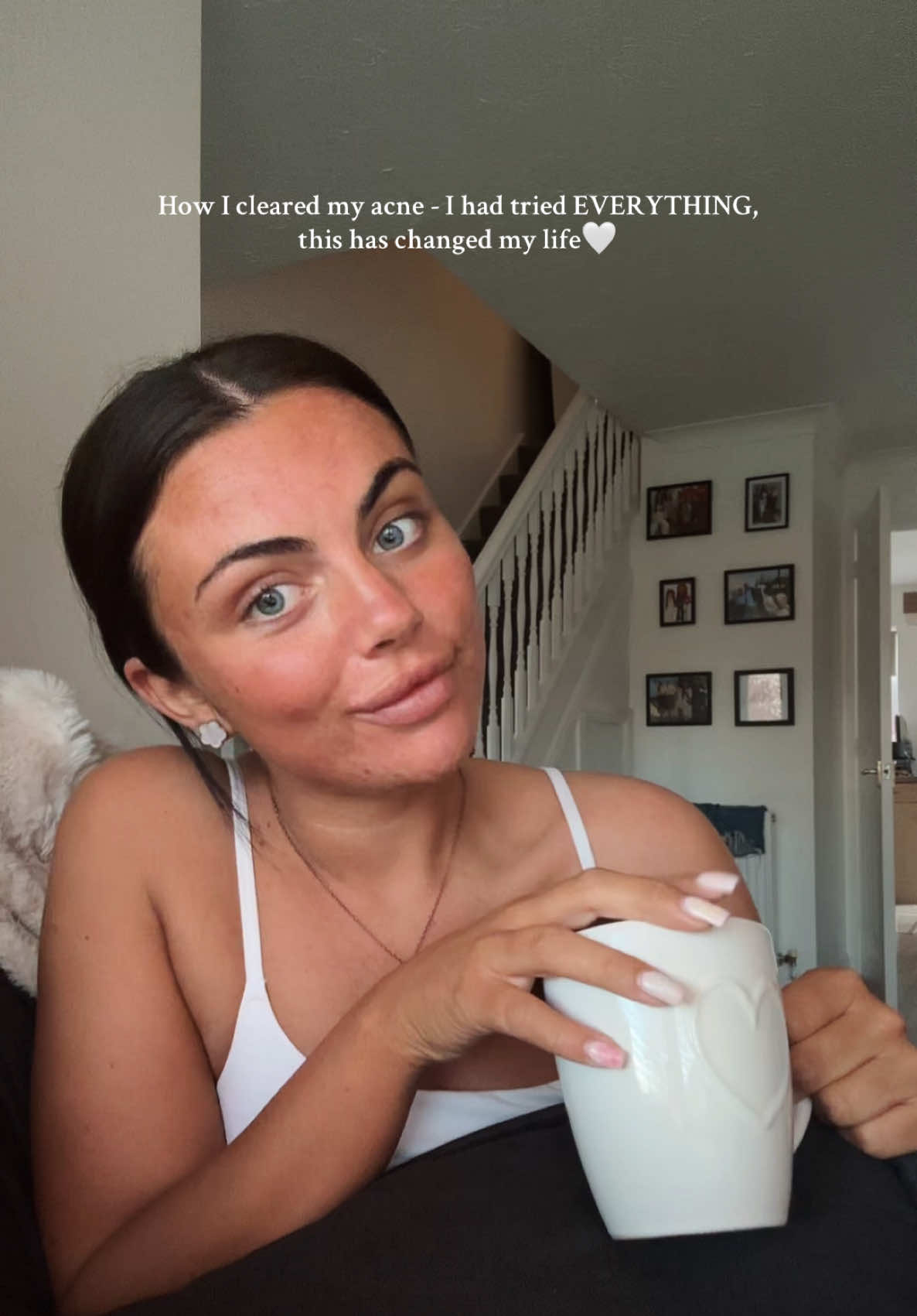 so so pleased @tanandglamsunbeds 🖤 #fyp #acne #acnejourney #skinjourney #badskin #clearskin 