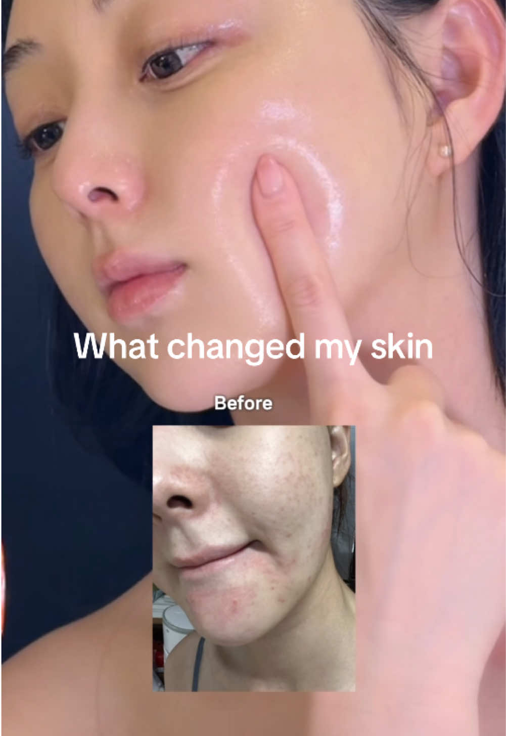 My skin used to be this bad before.🫢 @mixsoon #mixsoon, #mixsoon9step #koreanskincare, #glassskin,  #skintok, #kbeauty, #kbeautytok, #mixsoonroutine,    #skincareroutine, #kbeautyaddict, #TikTokMadeMeBuyIt, #mixsoonskincareroutine