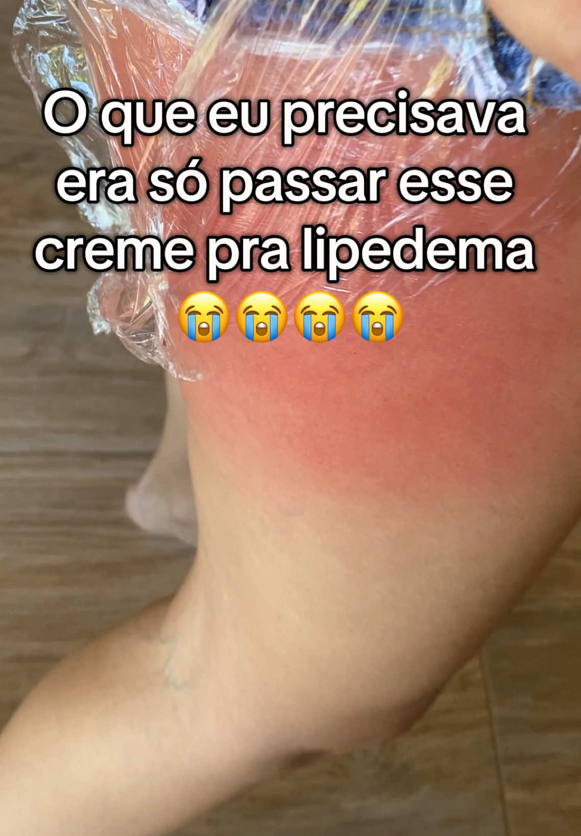 Nem acredito que está sumindo😭  #lipedema #celulitis #celulite #mulherbrasileira #autocuidadofeminino #creatorsearchinsights 