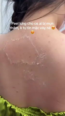 Peel lưng, giải pháp cho ce bị mụn thâm lưng nhé ạ !!! #CapCut #rivewlamdep #chamsocda #xuhuonglamdep #phunuvietnam #peelda 