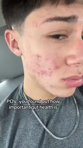 The transformation after taking care of my gut #guthealth #digestivehealth #snatched #acne 