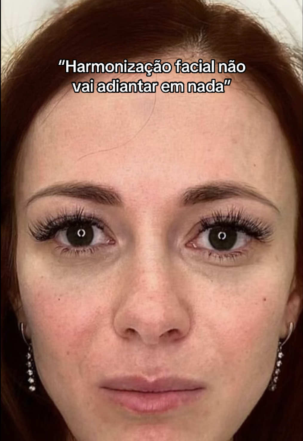 “Harmonização facial não vai adiantar em nada”  Olha só esse resultado incrível que essa paciente teve! Através de uma consulta, pudemos alinhar e criar com ela um protocolo e atendimento personalizado. Quer saber descobrir o que a harmonização facial pode fazer por você?  Agende já sua consulta conosco!  #clinicavanessacabral #capixaba #capixabadagema #vilavelha #praiadacosta #estetica #harmonizacaofacial 