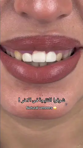 شوفوا النتيجة فى الاخر بالتركيبات التجميلية بعد تعديل شكل اللثة 😎