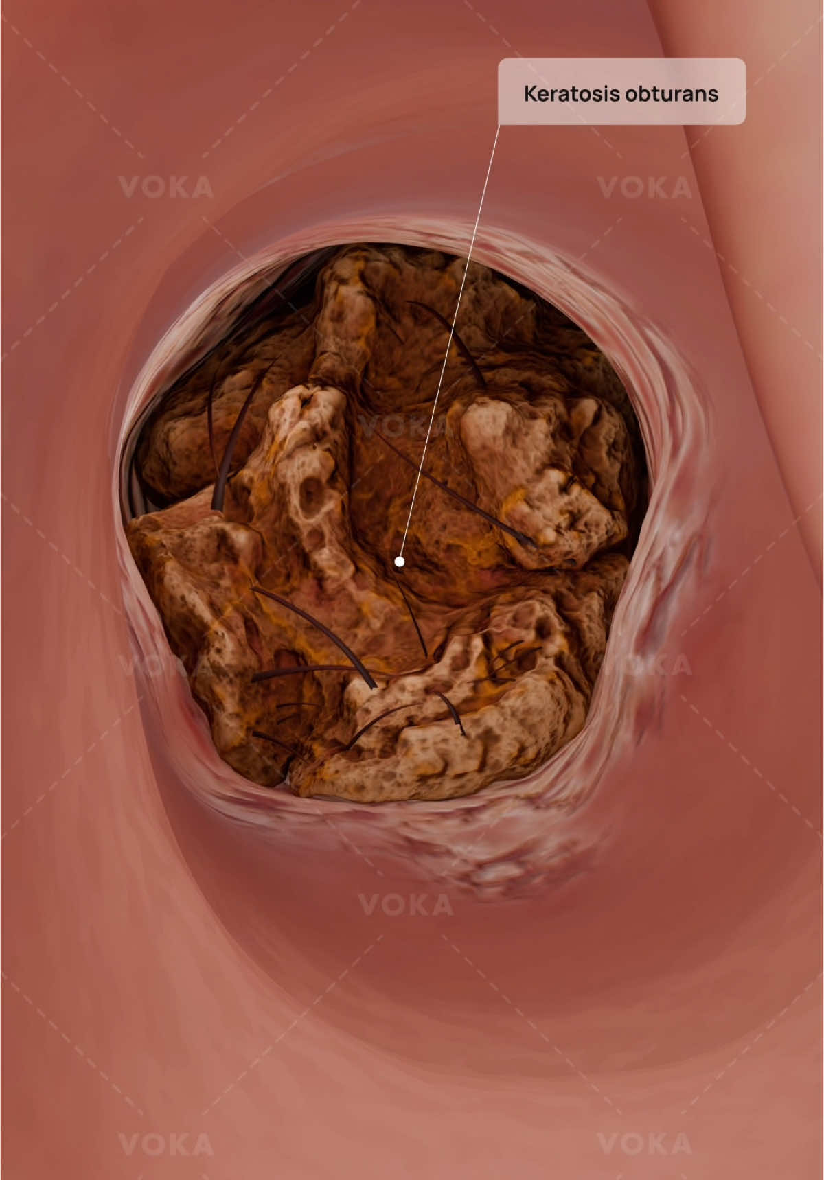 What is keratosis obturans and how does it impact the ear? Explore with VOKA in 3D   Keratosis obturans is a rare but impactful condition involving accumulation of dense keratin masses in the external auditory canal, often accompanied by inflammation and epithelial disruption. Unlike simple earwax impaction, these sulfur-like plugs are tightly adhered and may cause pressure erosion of the surrounding bone over time.   This condition often affects young adults and can be bilateral, though it may appear asymmetrical. The keratin buildup leads to significant canal obstruction, resulting in conductive hearing loss, discomfort, and recurrent otorrhea.   If left untreated, keratosis obturans can cause chronic inflammation, canal widening, and in some cases, bony sequestration. It's important to distinguish it from external canal cholesteatoma, which involves bone erosion due to invasive squamous epithelium.   Symptoms include:  🔸 Progressive hearing loss (typically unilateral at first) 🔸 Sensation of fullness or blockage in the ear 🔸 Intermittent ear pain or pressure 🔸 Occasionally, foul-smelling discharge   Treatment includes microsuction removal of keratin plugs and long-term monitoring to prevent recurrence. In more advanced or recurrent cases, canaloplasty may be considered.   📌 Explore the full 3D visualization of this rare pathology in VOKA Anatomy & Pathology!   #keratosisobturans #earpathology #otorhinolaryngology #ENT #anatomy #3danatomy #medstudents #medicalstudents #medicaltsudent #digitallearning #humanbody