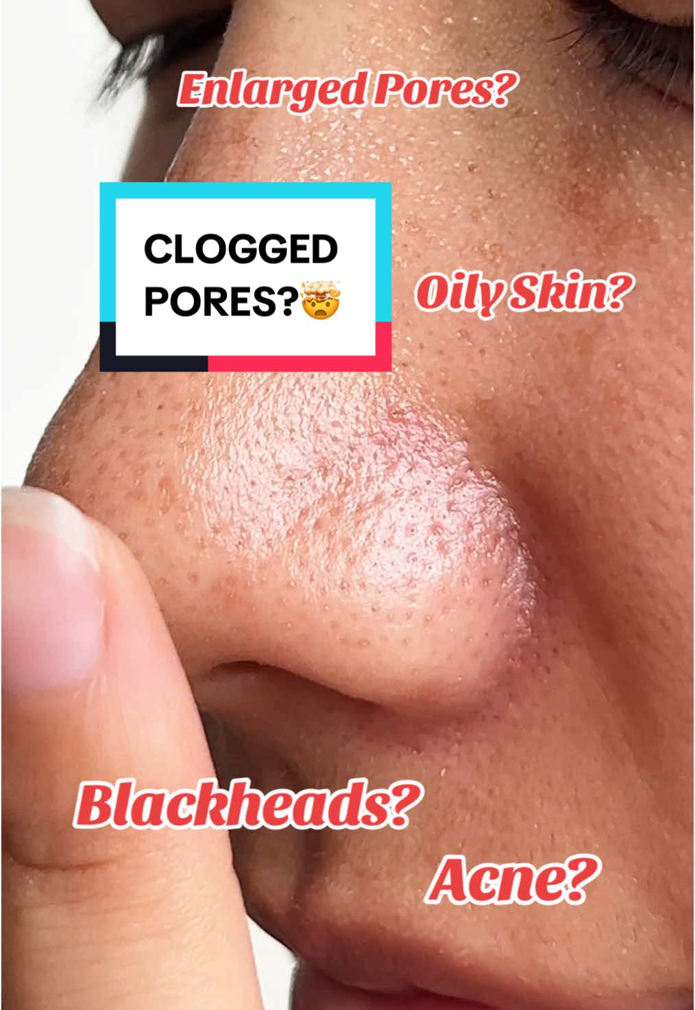 Say goodbye to oily skin, acne, and congested pores! The Purest Solutions’ Exfoliating Salicylic Acid Cleanser is a game-changer—formulated with 0.5% Salicylic Acid and 1% Niacinamide to deeply cleanse, unclog pores, and control excess oil without stripping your skin. Perfect for keeping breakouts at bay and your skin balanced! . . . . #skintok #skincareroutine #oilyskin #oilyskincare #pores #acne #acnetreatment #acnefighter #acneproneskin #nepali #nepalitiktok #nepal #goviral #fypnepal💜🇳🇵 #fypp 