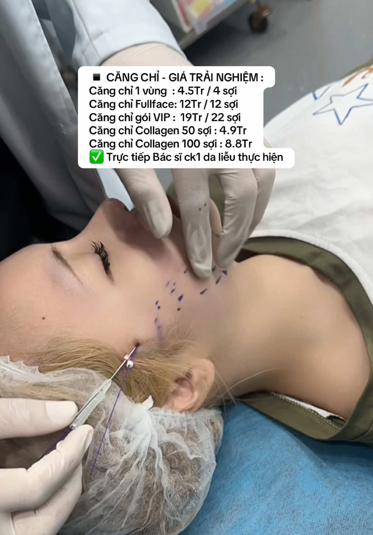 Căng chỉ nâng cơ , trẻ hoá khắc phục má chảy xệ #phongkhamdalieuqclinic #qclinic #pkckdalieuqclinic #cangchi #cangchinangco #cangchicollagen 