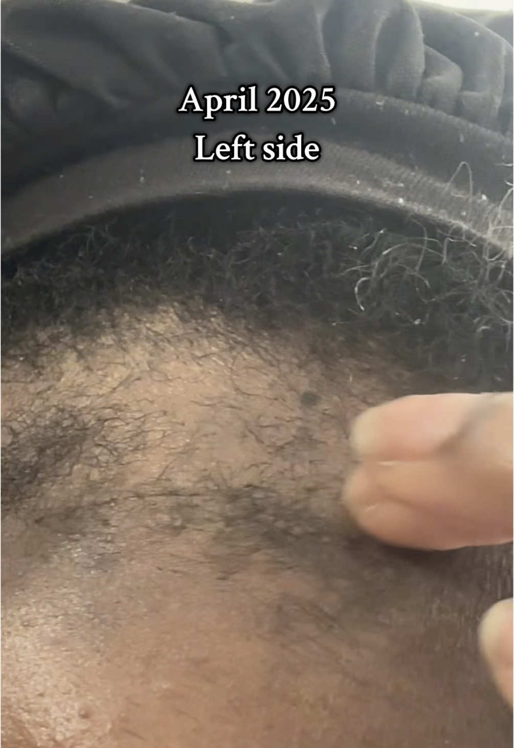 I need help 😭😭😭 has anyone experienced this before??? I don’t know what to do and my GP just isn’t being helpful right now. I’ve been dealing with this hair loss for over a year now and it’s just getting worse. I’ve tried using dermarollers and amla oil but nothinggg is helping 🫠 #helpme #hairlosssolutions #hairtok #blackgirltiktok #fyp #alopecia 