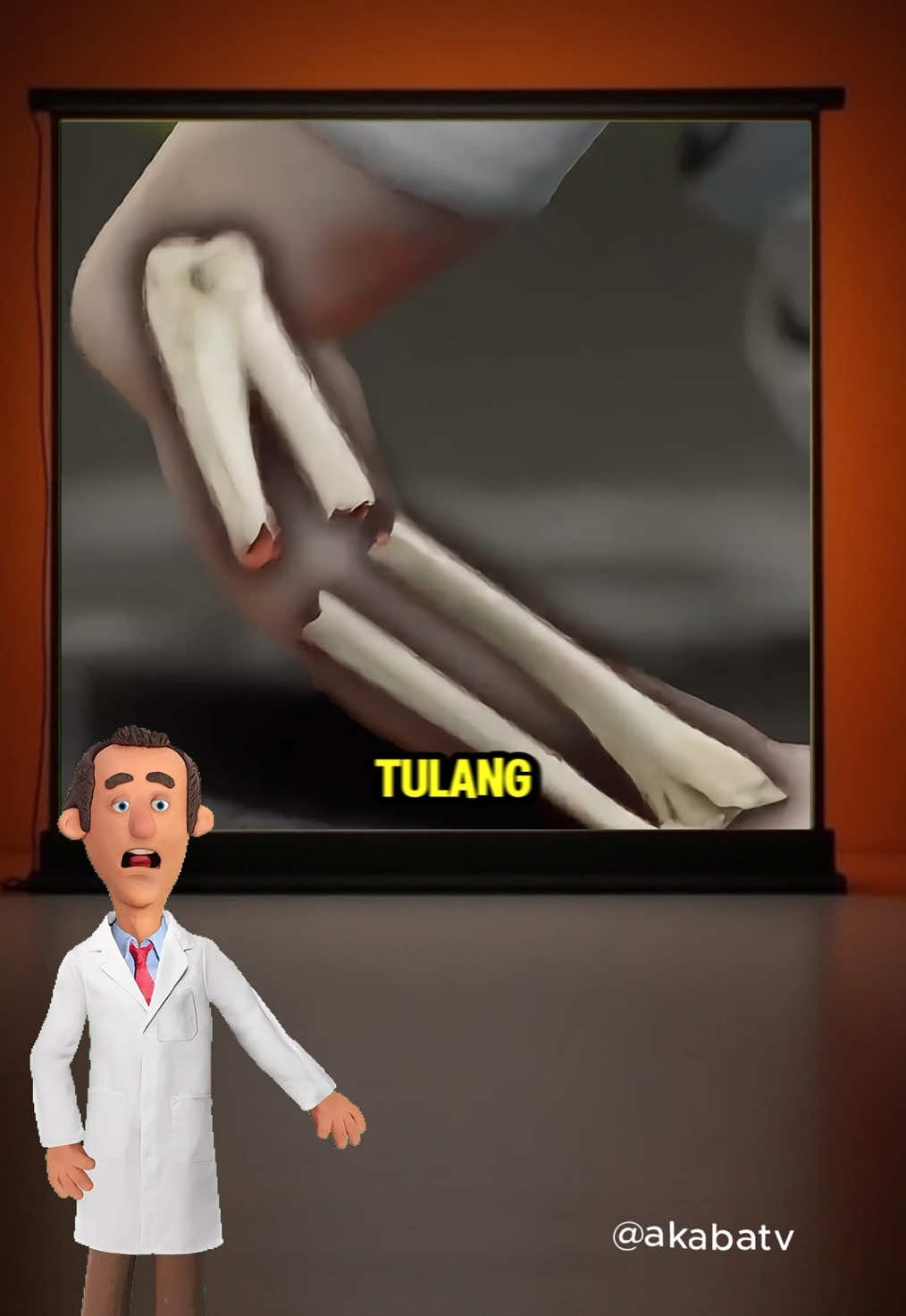 Jangan Anggap Remeh Patah Tulang! Kalau kamu mengalami patah tulang dan nggak segera ditangani, tubuh memang akan mencoba memperbaiki sendiri—tapi risikonya besar. Tulang bisa menyambung dengan posisi yang salah, menyebabkan nyeri, kaku, bahkan deformitas permanen. Dalam kasus ekstrem, aliran darah bisa terputus dan fungsi anggota tubuh bisa hilang.#patahtulang #infokesehatan #dokter #akabatv 