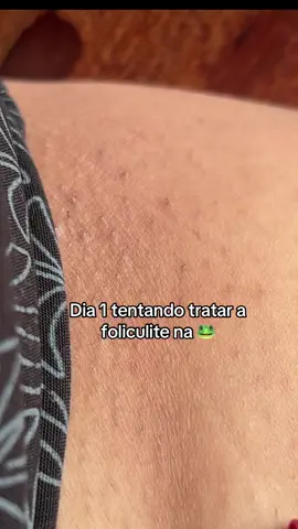 Nem acredito que consegui 😮‍💨😭 #foliculite #clareador #mulheres 
