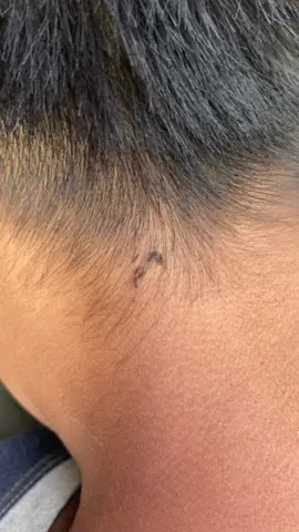 I can remove lice with my fingernails 😱😱#omg #lice #liceremoval #treanding 