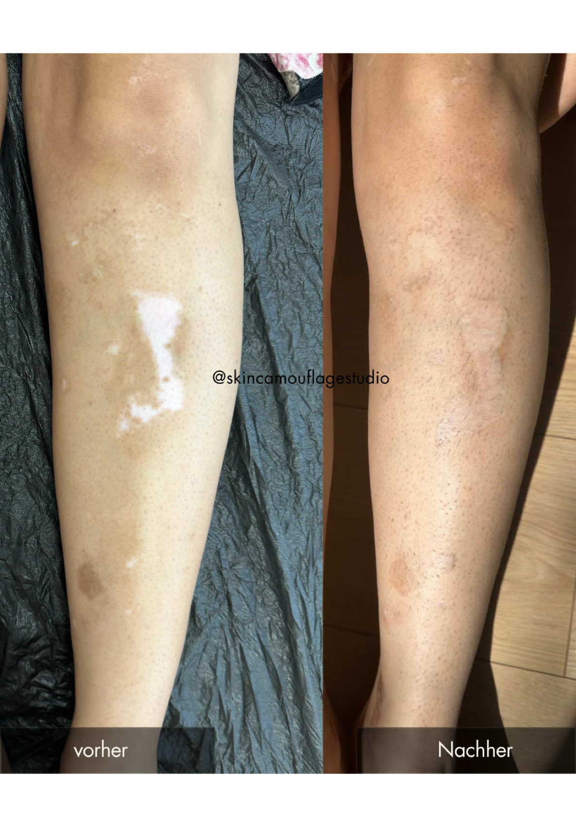 Diese Kundin kam mit einer Vitiligo zu mir. Seit ihrer Kindheit hat sie sich nie getraut, kurze Kleider oder Röcke zu tragen – es war ihr einfach zu unangenehm, weil sie ständig auf die Flecken angesprochen wurde. Nach zwei Sitzungen Camouflage Tattoo hat sich das verändert. Und ja – natürlich sieht man, dass es ein Tattoo ist. Aber der Unterschied ist so fein, dass sie sich zum ersten Mal richtig wohlfühlt in ihrer Haut. Heute kann sie sich frei bewegen. Und das ist alles, was zählt. Was das Ganze besonders herausfordernd gemacht hat: Rund um die Flecken hatte sie starke Hyperpigmentierung, die durch eine frühere Salbe und Sonneneinstrahlung entstanden ist. Sie arbeitet aber schon seit einiger Zeit mit aufhellenden Seren daran, und sobald die Hyperpigmentierung weiter zurückgeht, wird das Ergebnis noch harmonischer wirken. Ich bin einfach nur dankbar für ihr Vertrauen. 🥂🫶🏼 #vitiligo #vitiligotattoo #vitiligocamouflage #vitiligoskin #vitiligobeauty #skinpositivity #skinconfidence #skinjourney #camouflagetattoo #paramedicaltattoo #skincamouflage #scarcamouflage #medicaltattooartist #tattooforhealing #selbstliebe #selfacceptance #HealingJourney #bodyconfidence #empowermentjourney #traumaink #inneretransformation #tattoowiehl #vitiligotreatmentköln 