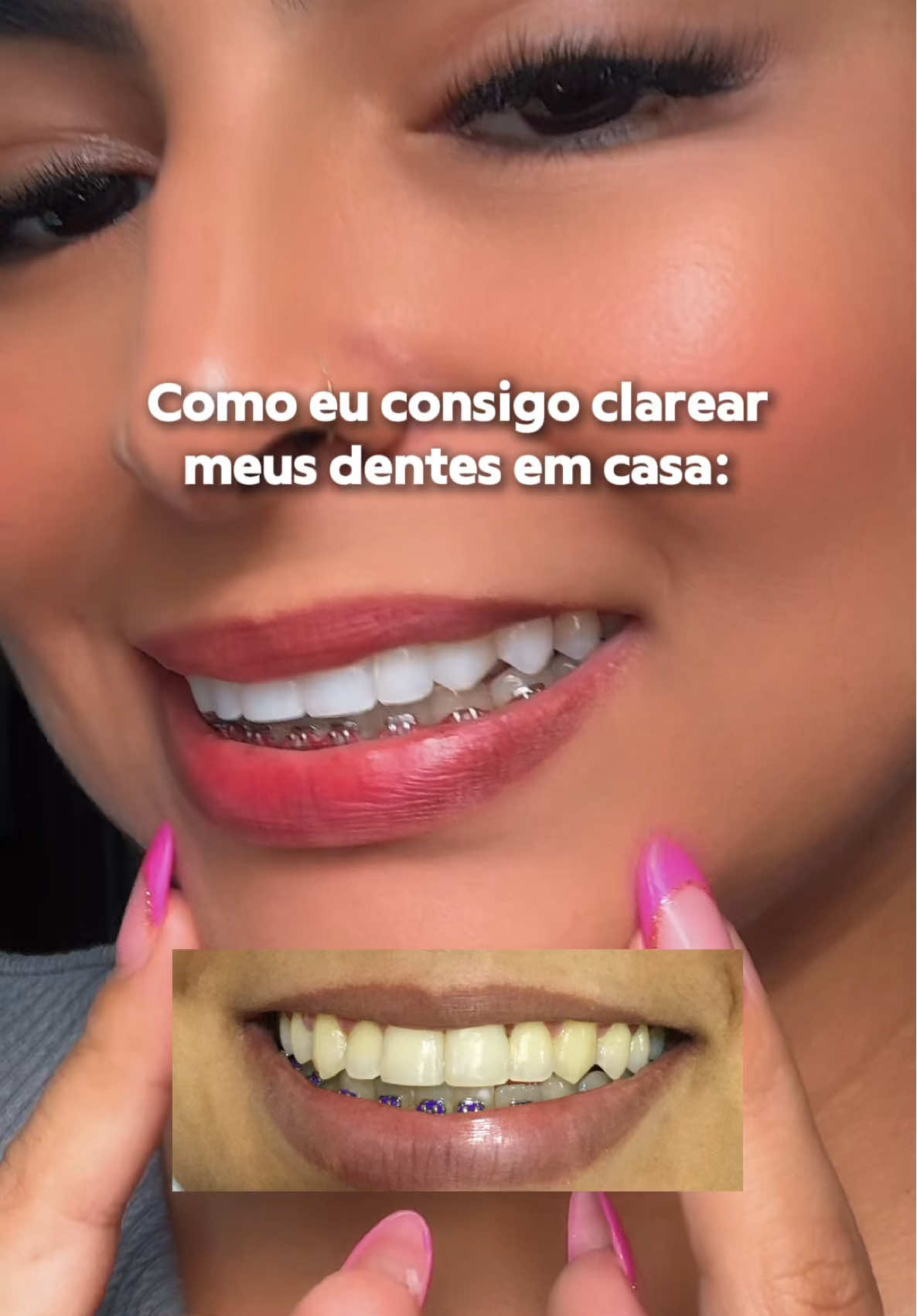 O clareamento caseiro que eu uso é esse aqui!! #clareamentodental #dentesbrancos #clareamentocaseiro 