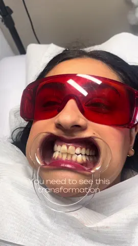 Before and after a 90 minute session 🦷 You can really see the shade difference 😍 Disclaimer: this lady’s 2 front teeth are known as ‘dead teeth’ these are teeth that have lost their nerves and don’t respond to traditional whitening because the discoloration comes from within, not just surface stains, however surface stains on them teeth can whiten, as you can see here!  ☑️ Instant results  ☑️ Suitable for sensitive teeth  ☑️ Confidence boost  ☑️ Affordable  ☑️ Results can last up to a year  DM us to book ⭐️ Please note: everyone’s results are different due to lifestyle, type of staining, genetics etc, your teeth also have a natural stop point to how white they can go. Some clients may need more sessions to achieve their desired results.  #teethwhitening #teethwhiteninglondon #londonteethwhitening #whiteteeth  #teethwhiteningtechnician #pearlywhiteteeth #teethwhiteningbusiness #explore #teethwhiteningresults #smiletransformation #trendingreels #cosmeticteethwhitening 