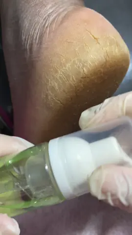 ✨Produtos usados nesse spa dos pés✨ Um cuidado simples, mas que faz TODA diferença no resultado! 	1.	Hidracalo – Esse amolecedor é incrível! Deixa a pele mais molinha, facilitando a remoção de calos e peles mais grossas.💖 	2.	Esfoliante da SIE – Um passo essencial! Ajuda a remover as células mortas e deixar os pés super lisinhos. 	3.	Manteiga Hidratante da SIE – Finalizei com essa manteiga poderosa que hidrata profundamente e deixa um toque maravilhoso.💁🏻‍♀️ 	4.	Produtos da Shein (ID 17183149) (ID: 43469910 e 39469721) – Produtos muito bom que realmente funciona! 🤌🏼 🏷️ Cupom: 25q1caaf3 🏃‍♀️Agora, se você quer aprender de verdade como cuidar das suas unhas das mãos e usar os produtos certos pra ter resultado de salão em casa…🛒🛍️ O meu e-book foi feito pra você! Cheio de truques, produtos que eu uso, técnicas simples e tudo explicado do jeito mais direto possível.🩷 Tá no meu Beacons — clica no link e garante o seu agora! Você vai amar!💖