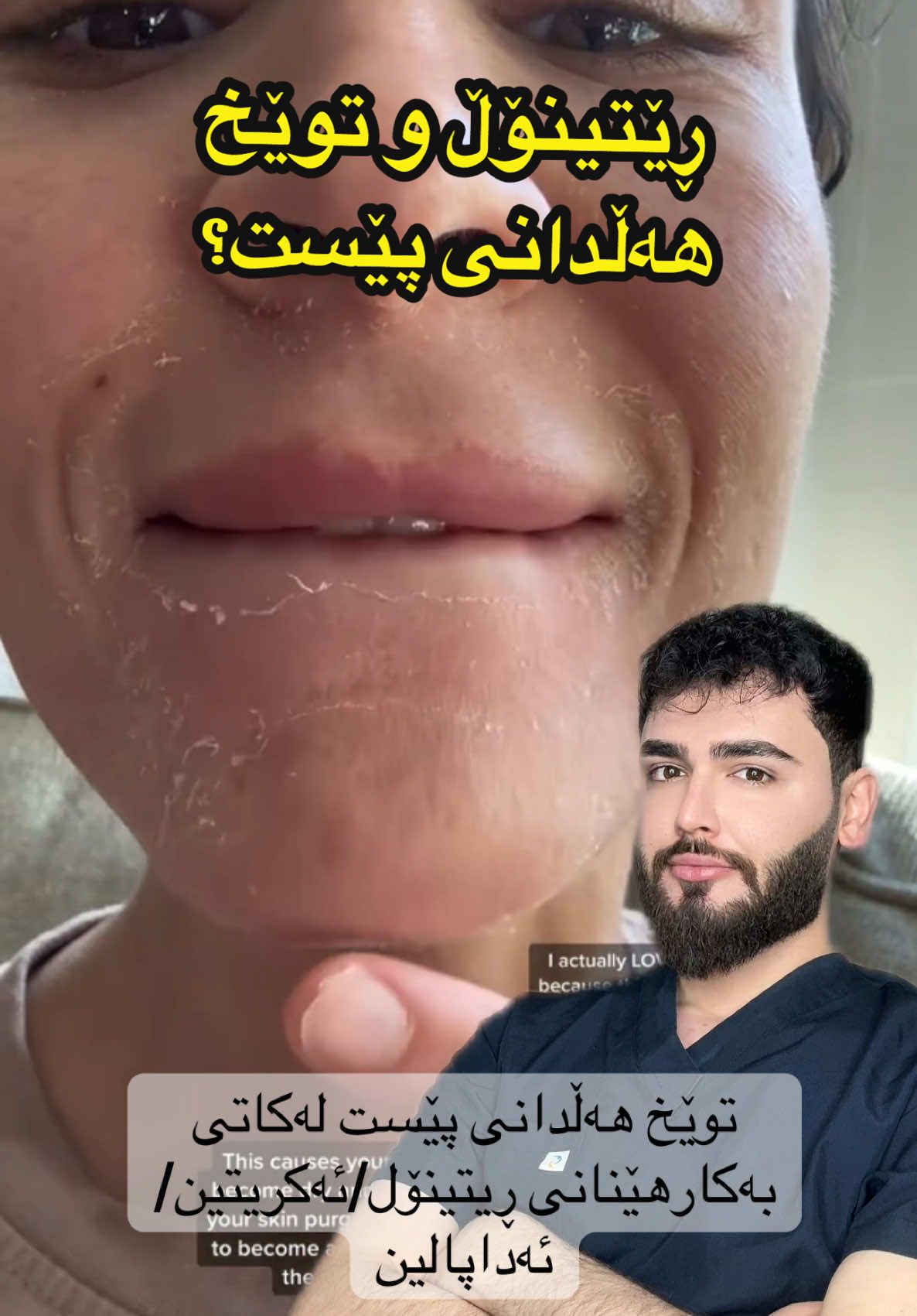 چۆن مامەڵە لەگەڵ توێخهەڵدانی پێستت دەکەی لەکاتی بەکارهێنانی رۆتینێکی نوێ کە ڕێتینۆلی تێدابێت؟ #fyp #foryoupageofficiall #tiktokviral #skin #flaky 