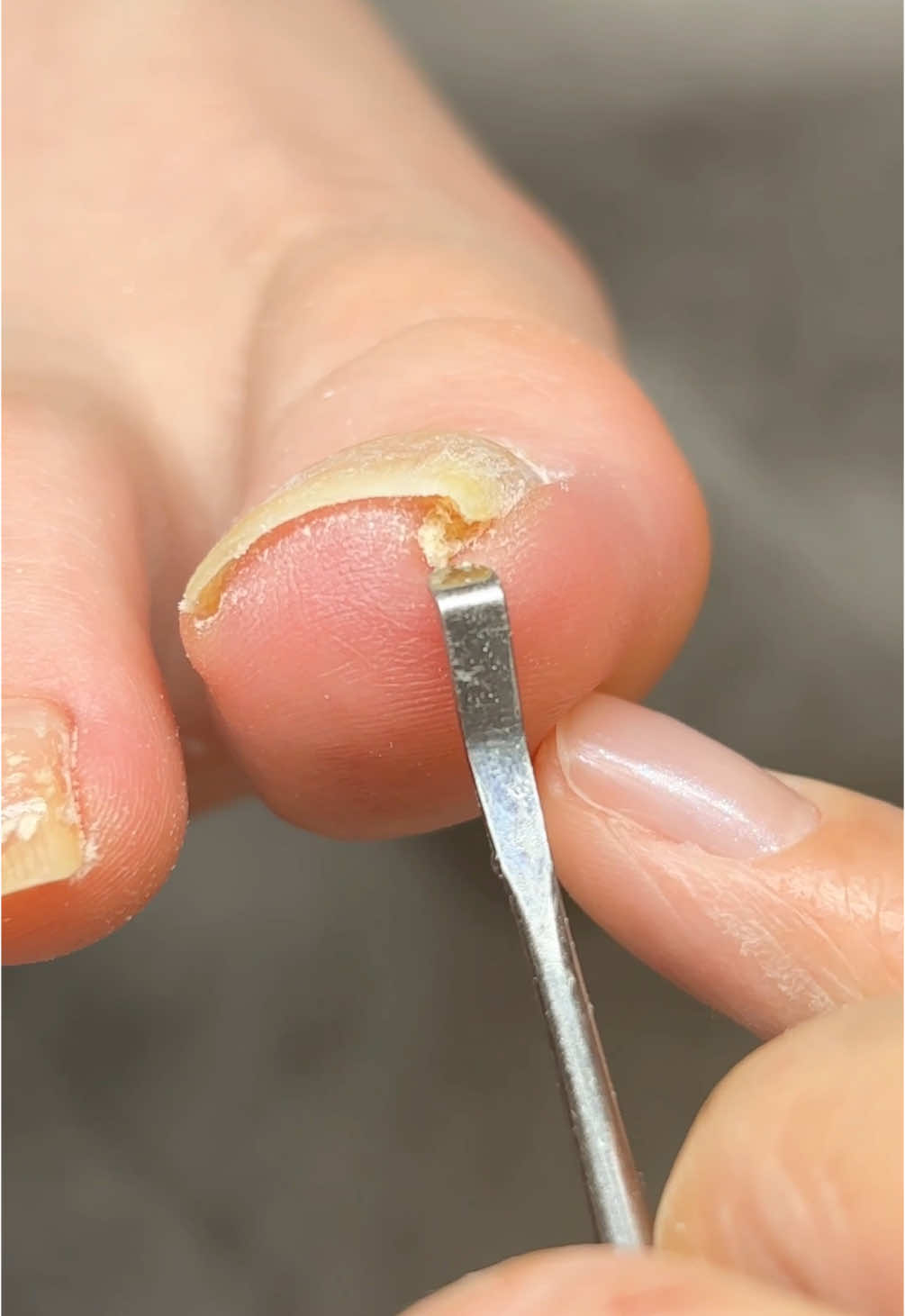巻爪ケアをしていると出てくるこの角質たち😌 爪に押されて痛む箇所を皮膚が守ろうとしてできた防御反応です🧹 この角質をしっかりお掃除することで、 巻爪による圧迫感や痛みの緩和、ムレや匂いの軽減、清潔感UPなど嬉しい変化があります✨ 見えない部分も綺麗に😌✨ 仕事のお話で私も一緒にテンション上がりました😂今日もありがとうございます🌼 ▼フットネイルケア フットバス＋長さ形整え＋甘皮ケア＋指まわりの角質除去＋表面磨き＋足裏の角質除去＋保湿仕上げ 🕗80分　💰11,000円 ▼トラブルネイル ※症状により別途料金・お時間を頂く場合がございます。  ※ご新規さまは事前にLINEにてカウンセリングをお願いしております。LINEにてご希望の旨ご連絡くださいませ。 🕗＋30分〜/1本　💰＋5,500円〜/1本 #hachinailcare