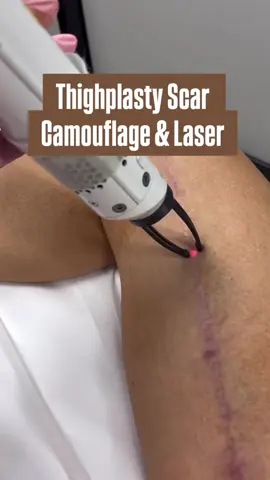 Camouflage for Thigh Lift Scar after surgery. Scar tissue repair, then scar camouflage using ink. Love your body after surgery, but don’t love the scars? Follow to learn more about our scar treatments including Scar camouflage tattoo and a customized laser packages for scars  #weightlosssurgeryjourney #scarremoval #plasticsurgeryscars #thighplasty #scarcamouflagedallas #scarcamouflageaustin #laserscar #scarspecialist 