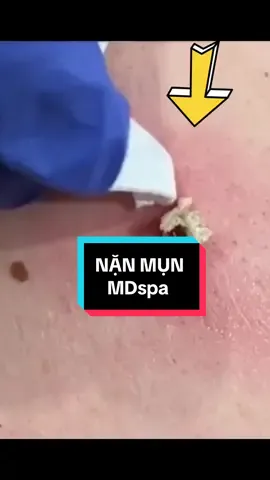 #nặn_mụn #lêthithuydung616 #chuyên_đtri_mụn_rỗ_tpvinh_nghệan #chuyên_đtri_sẹo_tpvinh #mdspa_chuyên_mụn_rỗ_tpvinh 