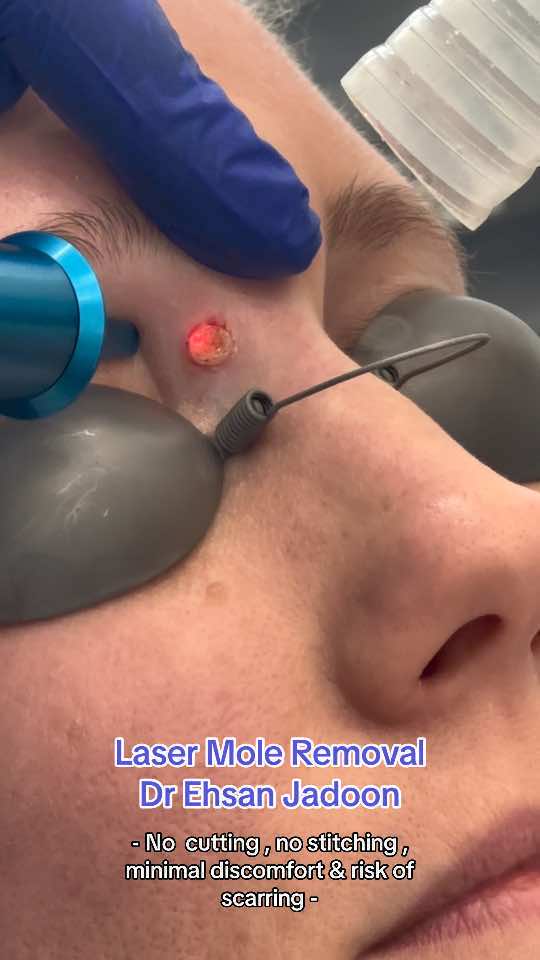 #cosmeticsurgery #plasticsurgery #lasermoleremoval #dermatologydoctor #dermatology #lasertreatment #cosmeticclinicperth #perthcosmeticdoctor #perthnow #subiacoperth #rockingham #skin 