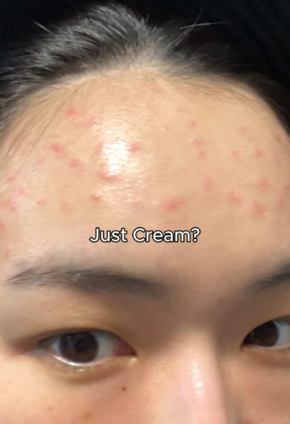 #acnescars #acnemarks #acneskin #acneproneskin #sensitiveskin #acnejourney #skincareproducts #mugwortcream #orienmugwortcream #oriencream #orien #orienskincare #skintok #skincarehacks #beforeandafter #skincarevideo #creamrecommendation #koreanskincare #bumpyskin #flawlessskin #glassskin #foryou #koreangirl #fyp #acnecream #acnetreatment 